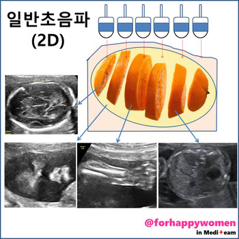 일반초음파1.jpg