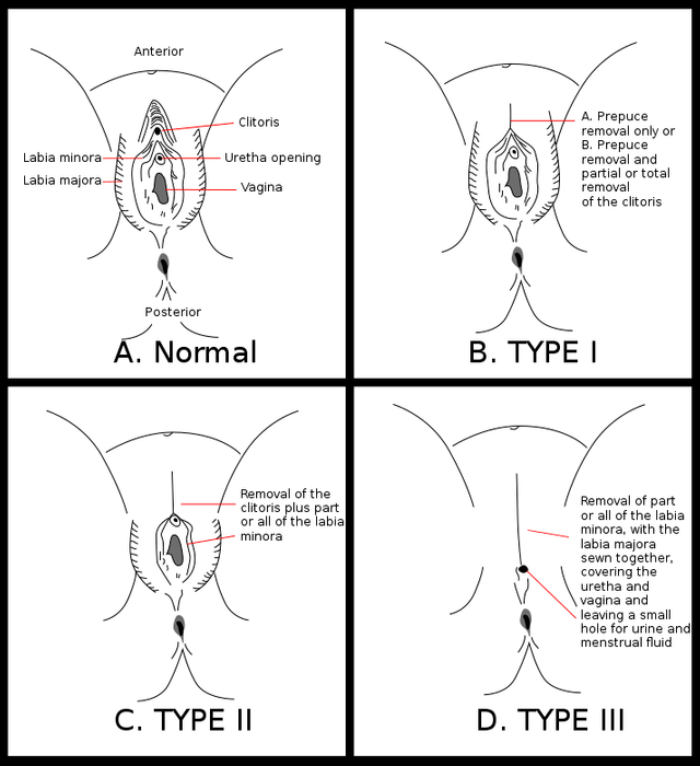 Female Genital Mutilation: Types, prevalence, causes and effects. — Steemit