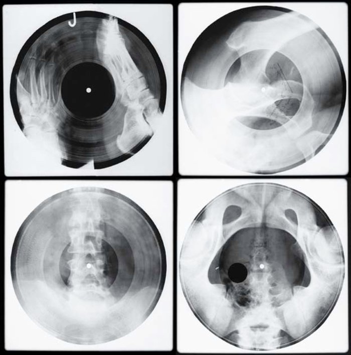 Записано на костях. Пластинки на рентгеновских снимках СССР. Пластинки на костях. Пластинка на рентгеновском снимке. Виниловые пластинки из рентгеновских снимков.