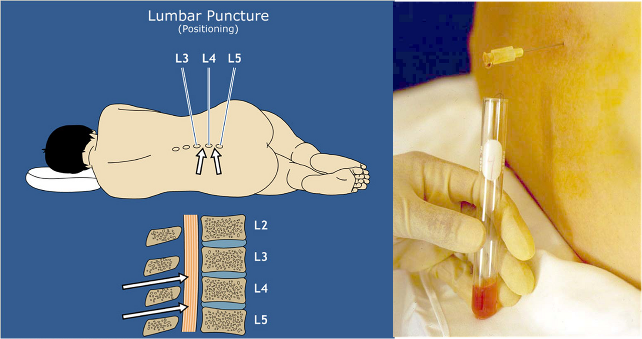 Люмбальная пункция презентация
