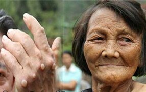 Wabah-Aneh-Penyakit-Kutil-Ganas-di-Cina-1.jpg