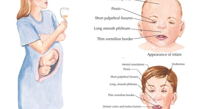 Алкогольные дети признаки. Алкогольный синдром плода (ФАС). Дети алкоголиков внешние признаки синдрома. Алкогольный синдром внешние признаки. Фетальный алкогольный синдром у детей внешние признаки.
