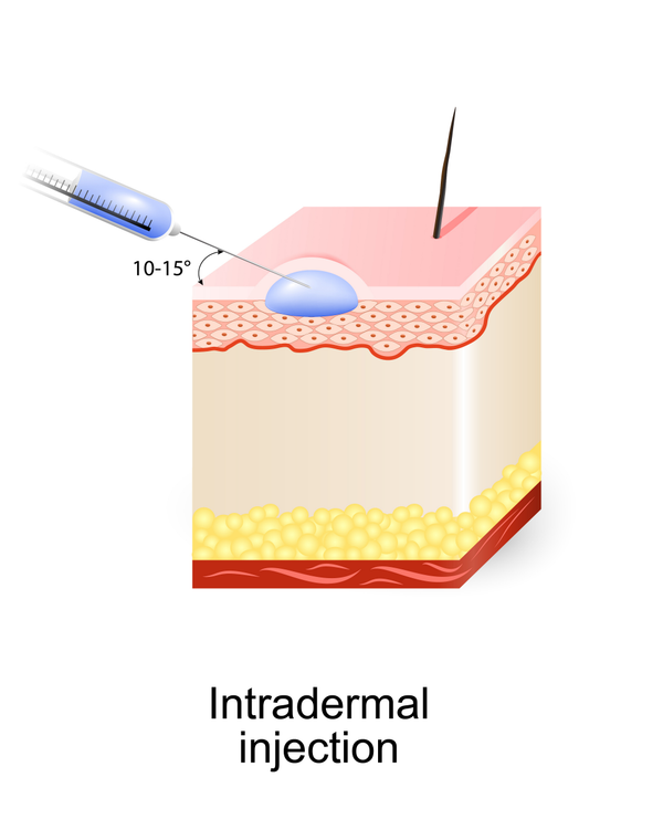 intradermal.png