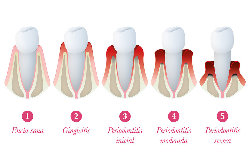 periodontitis-1024x683.jpg