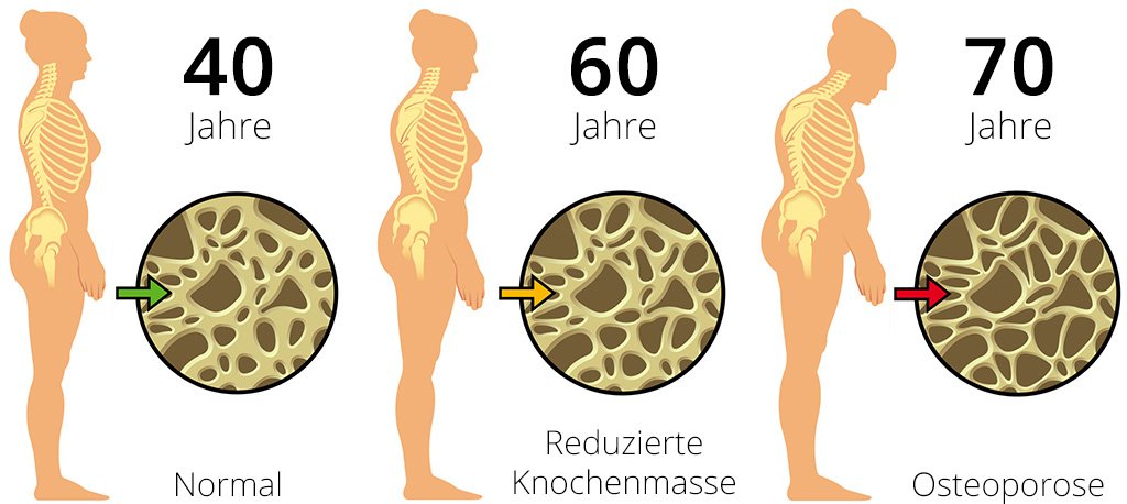 заболевание костей остеопороз. между остеопорозом и. остеопения и остеопороз разница. остеопороз структура. остеопения l1 l2 позвонков.