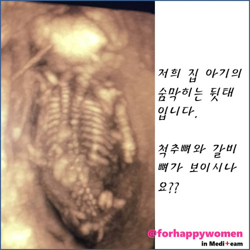 정밀초음파편4.jpg