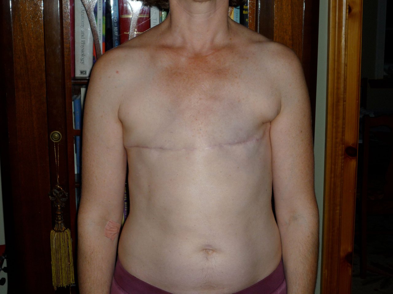 операция по удалению груди у женщин фото 107