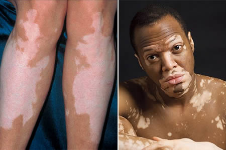 Effects and causes of LEUCODERMA — Steemit